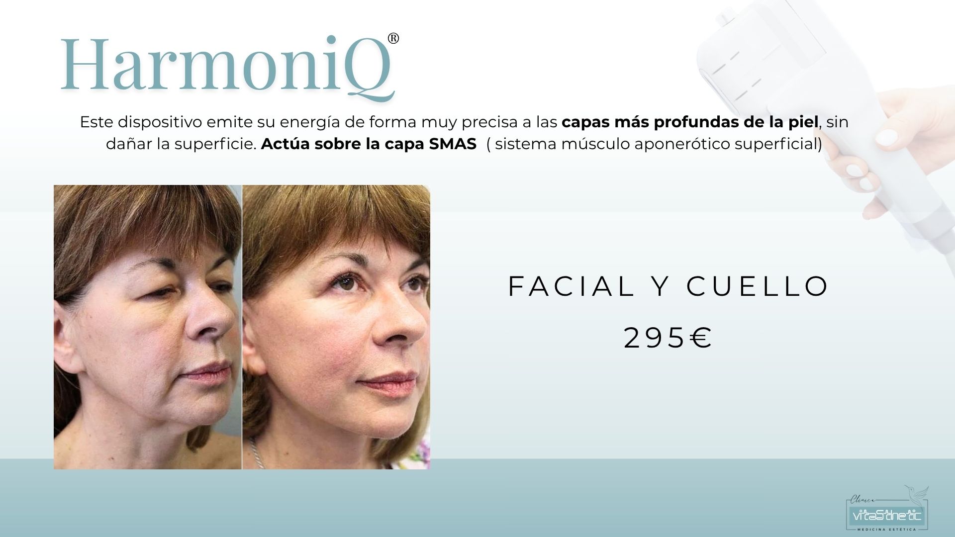 MEJOR HIFU DE GRANADA. ELIMINAR FLACIDEZ FACIAL, ELIMINAR ARRUGAS CUELLO