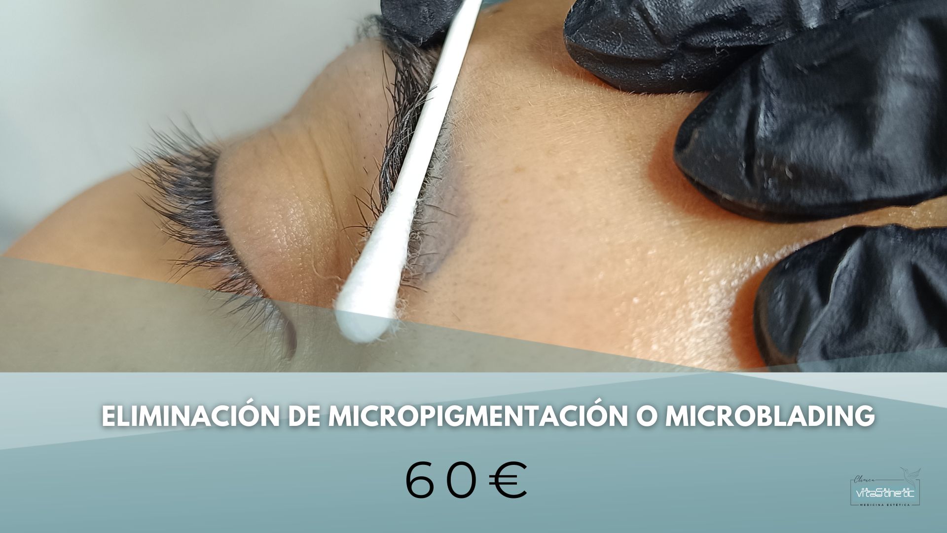 ELIMINAR MICROBLADING EN GRANADA. ELIMINAR MICROPIGMENTACION EN GRANADA